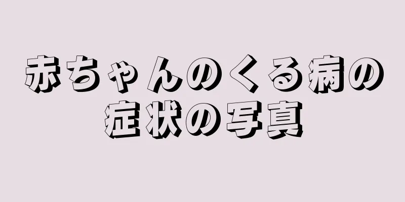 赤ちゃんのくる病の症状の写真
