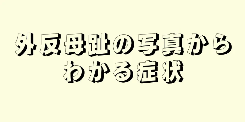 外反母趾の写真からわかる症状