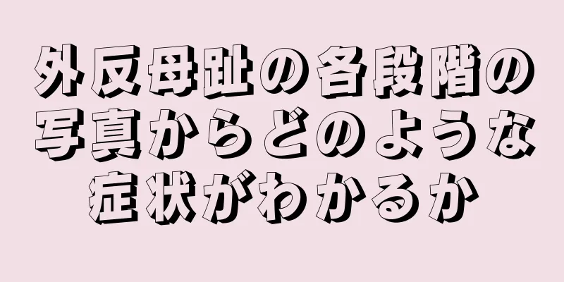 外反母趾の各段階の写真からどのような症状がわかるか