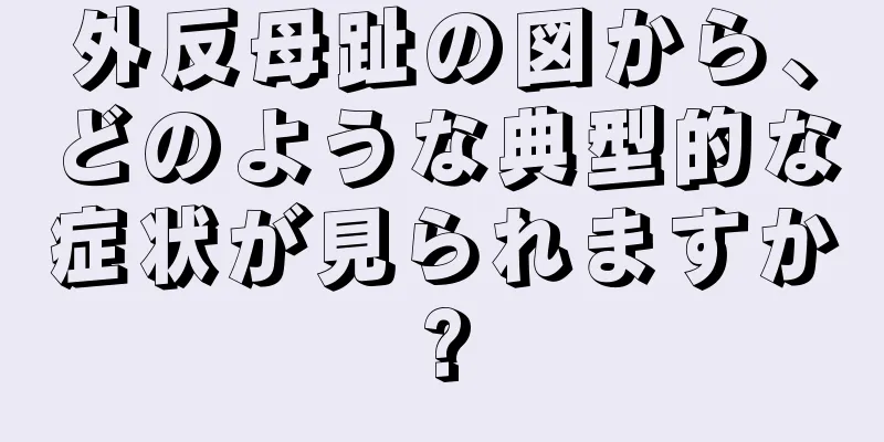 外反母趾の図から、どのような典型的な症状が見られますか?