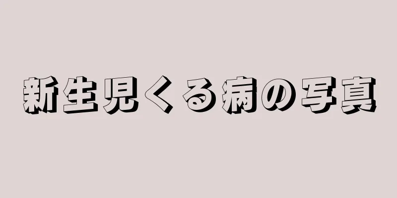 新生児くる病の写真