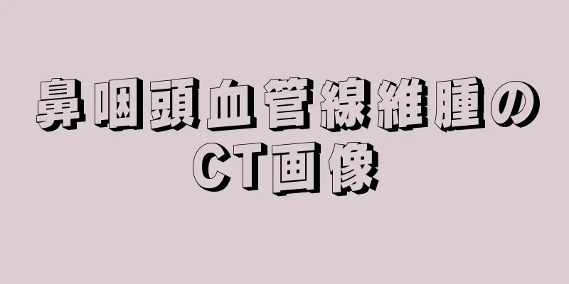 鼻咽頭血管線維腫のCT画像
