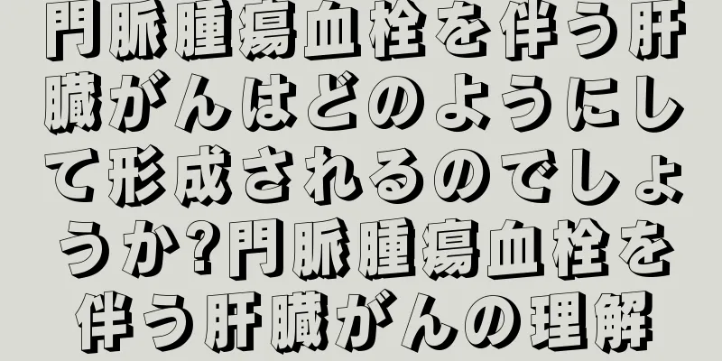 門脈腫瘍血栓を伴う肝臓がんはどのようにして形成されるのでしょうか?門脈腫瘍血栓を伴う肝臓がんの理解