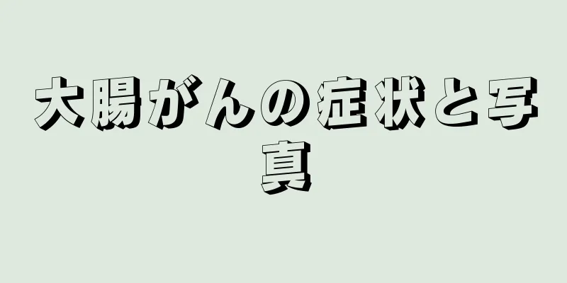 大腸がんの症状と写真