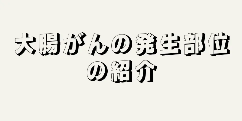 大腸がんの発生部位の紹介